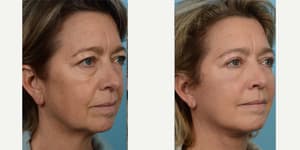 Rhinoplasty (Nose Job) procedure image