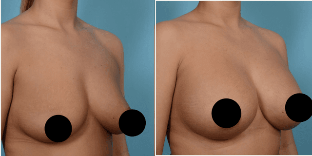 Breast Augmentation procedure image